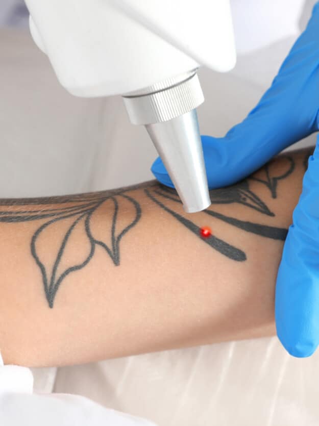 Skin Design Tattoo Removal